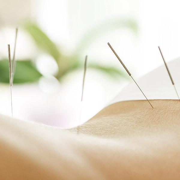 Alternative medicine. Close-up of female back with steel needles during procedure of acupuncture therapy.